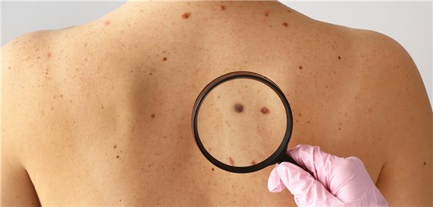 Dermatologe bei der Untersuchung von Muttermalen eines Patienten in der Klinik.